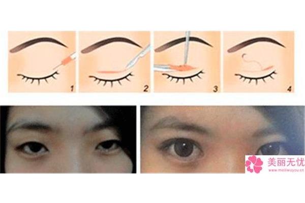 割了双眼皮可以吃鸡蛋吗