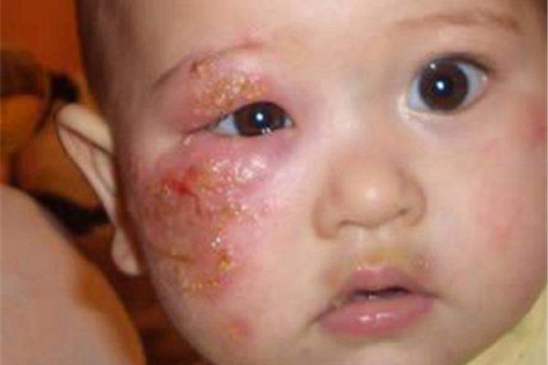 梅毒患者可以要孩子吗