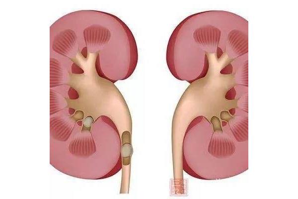 肾结石可以吃泡面吗