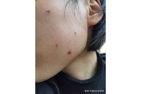 点痣后几天可以洗脸