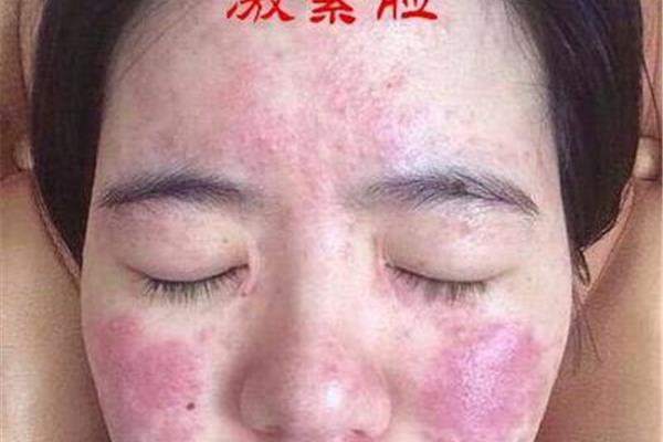 激素脸过敏怎么治疗可以彻底好