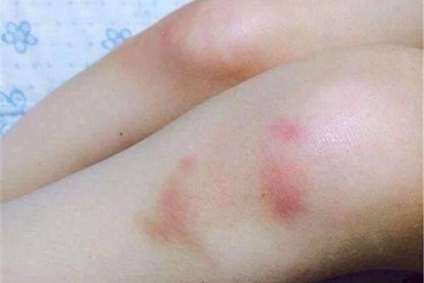 淤青可以冰敷吗